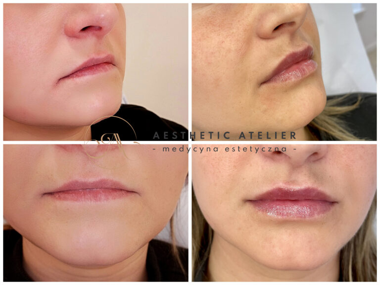 Powiększenie i modelowanie ust kwasem hialuronowym.