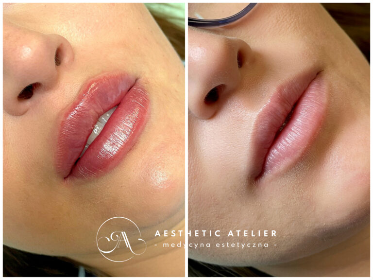 Russian lips - powiększenie i modelowanie ust za pomocą kwasu hialuronowego metodą "na płasko"