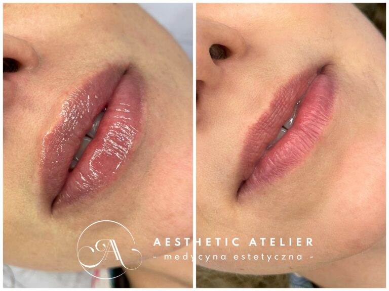 Powiększenie i modelowanie ust kwasem hialuronowym.
