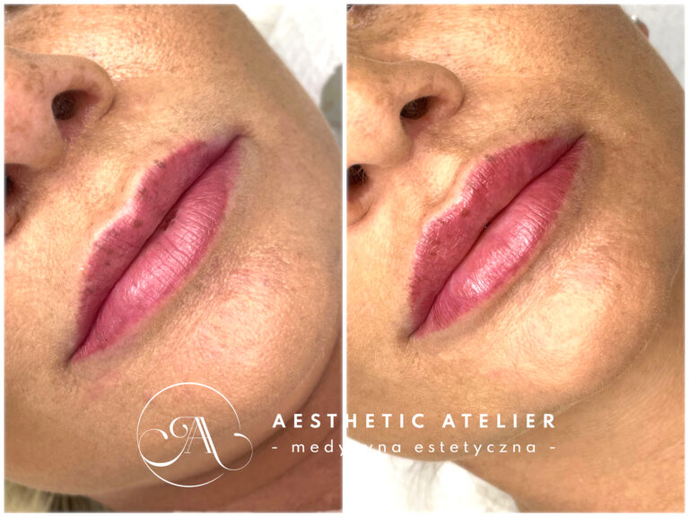 Powiększanie ust kwasem hialuronowym oraz podkreślenie rynienki podnosowej.