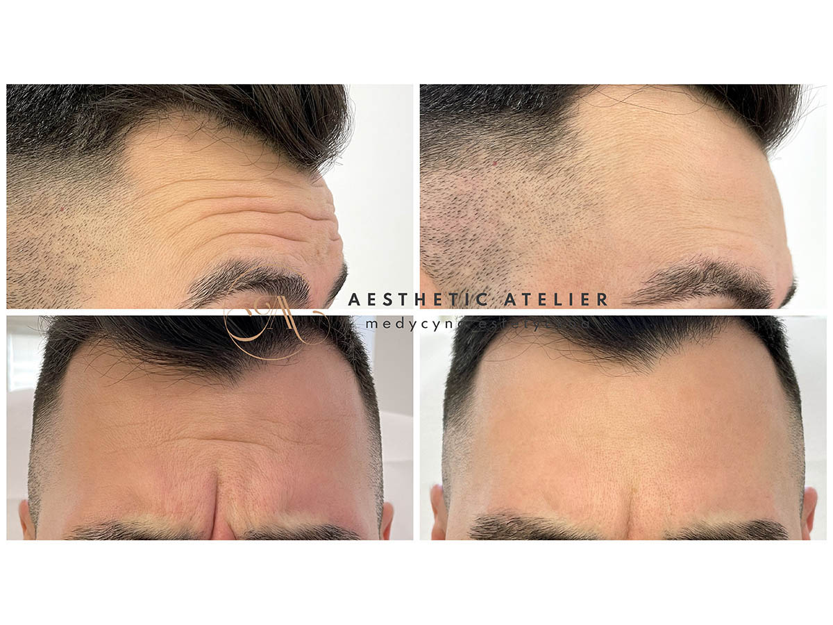 tomasz-likwidacja-zmarszczek-1