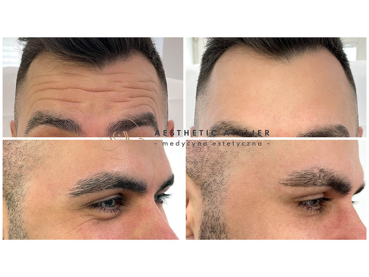 tomasz-likwidacja-zmarszczek-2