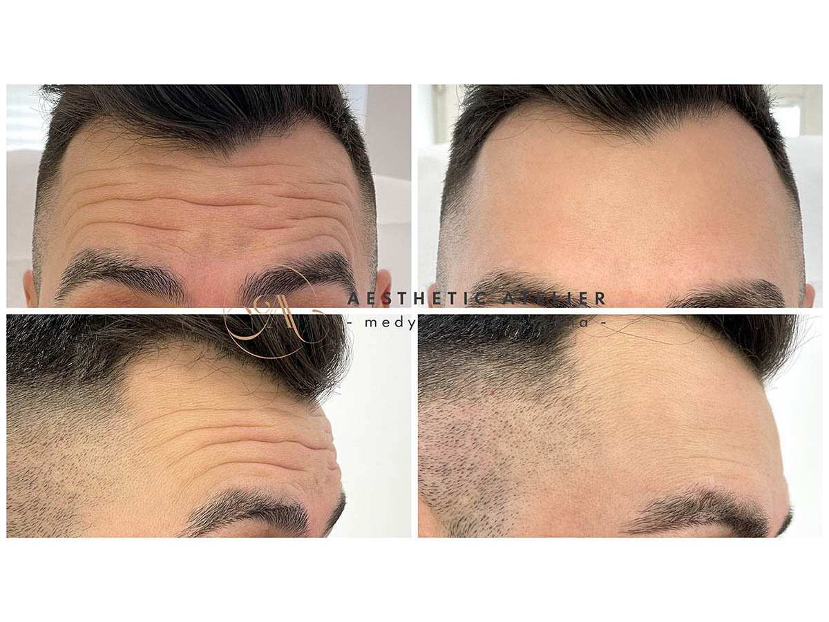 tomasz-likwidacja-zmarszczek-3