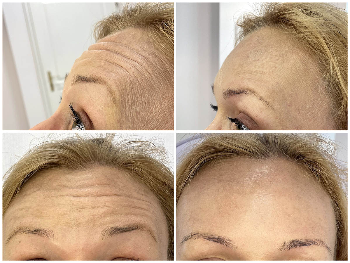 usuwanie-i-wygladzanie-zmarszczek-5