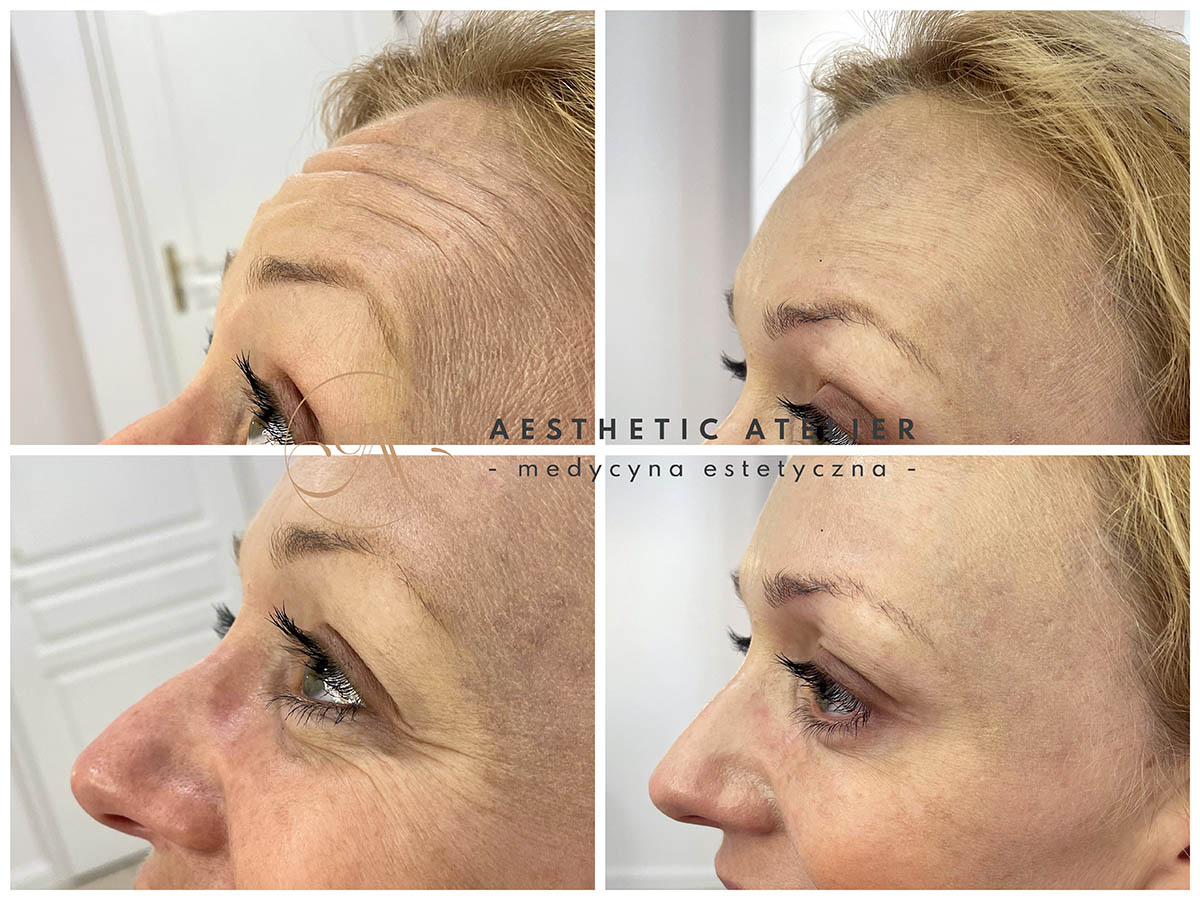 usuwanie-i-wygladzanie-zmarszczek-6
